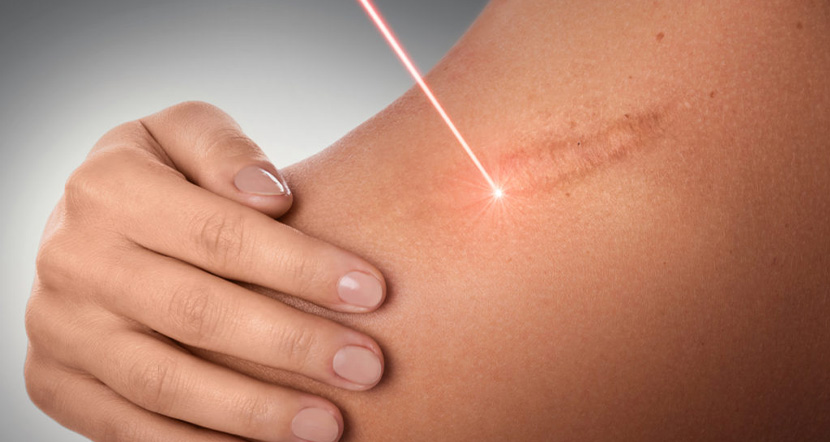 laser_scar_corection.jpg