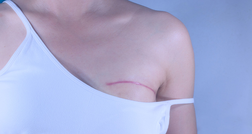mastectomy.jpg