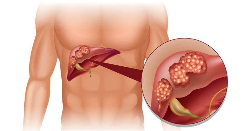liver_cancer.jpg
