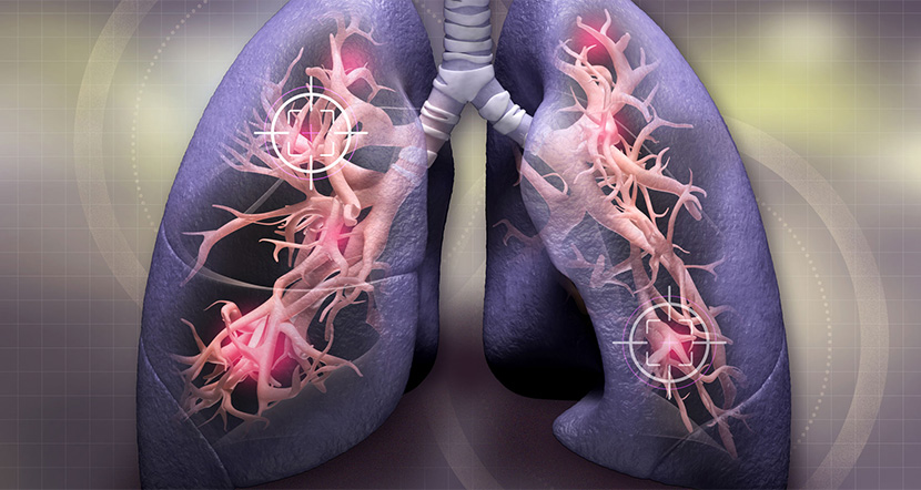 lung_cancer.jpg