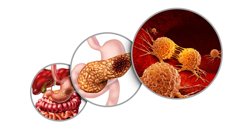 pancreas_cancer.jpg