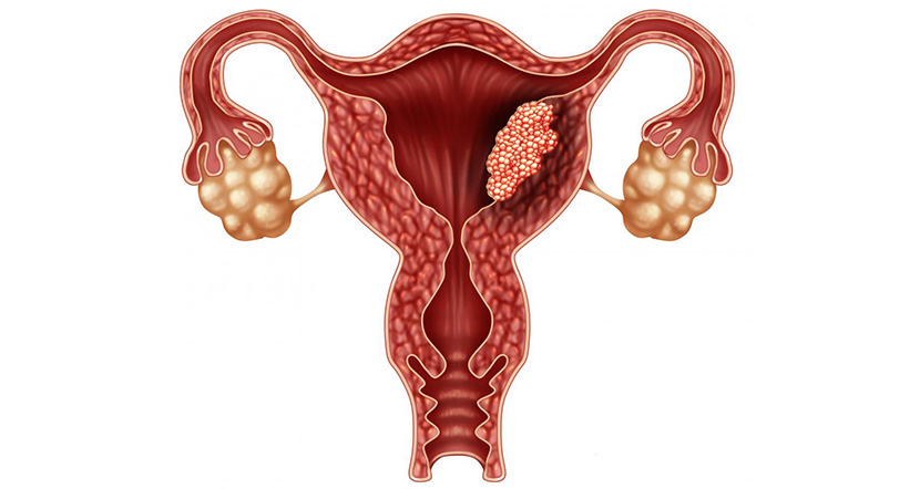 uterine_cancer.jpg