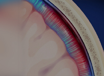 Гематома::Хірургічне лікування гематом