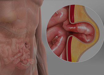 Грижа::Оперативне лікування гриж
