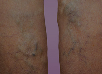 Варикозна<br />хвороба::Хірургічне лікування варикозного розширення вен