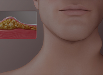 Ліпома::Хірургічне видалення ліпоми