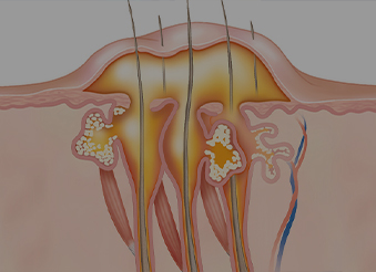 Абсцес::Лікування та розкриття гнійників