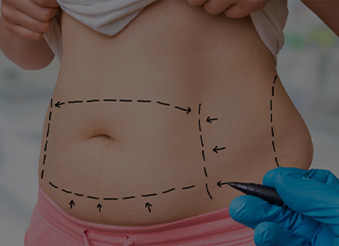 Абдомінопластика::Послуги з абдомінопластики