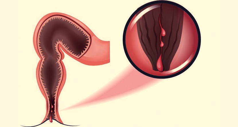 anal_fissure.jpg