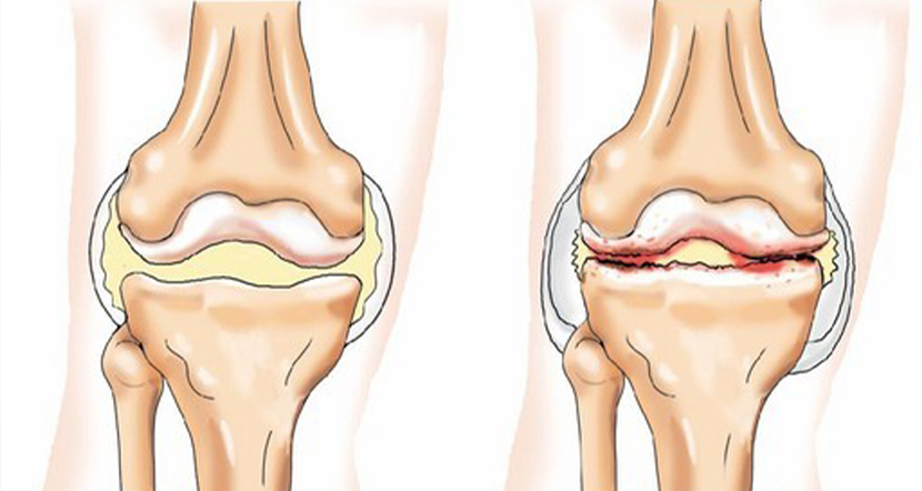 artroz_kolinnogo_sugloba.jpg