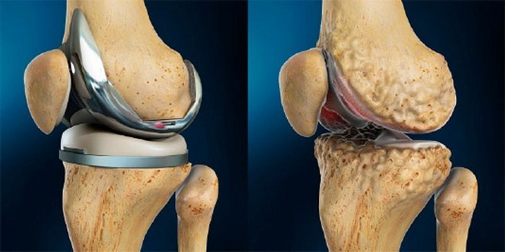 artroz kolinnogo sugloba4