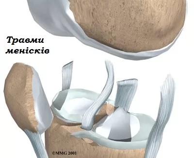 menisk