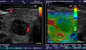 Еластографія в Івано-Франківську