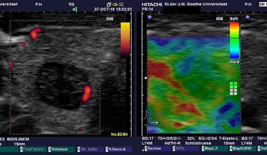 Еластографія в Івано-Франківську