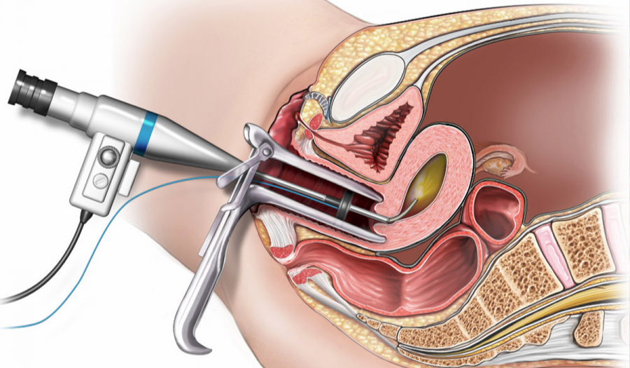 Гістероскопія