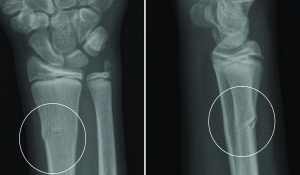 Перелом променевої кістки в «типовому місці»