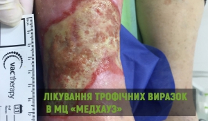 Лікування трофічних виразок в МЦ «МЕДХАУЗ»