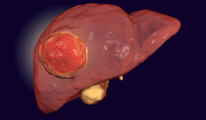 Рак печінки посідає п'яте місце серед усіх злоякісних новоутворень.
