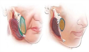 Комочки Біша - видаляти чи залишати?