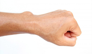 Гігрома, що це за новоутворення, методи діагностики та лікування