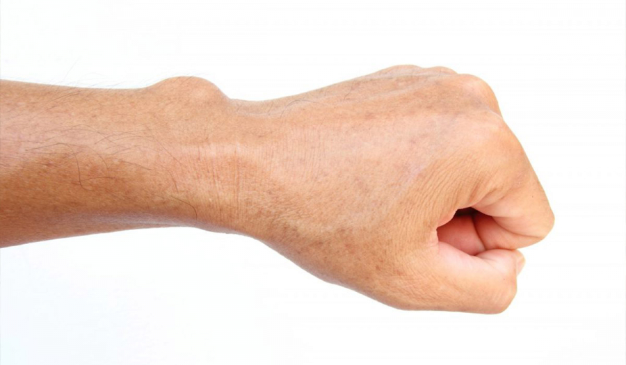 Гігрома, що це за новоутворення, методи діагностики та лікування