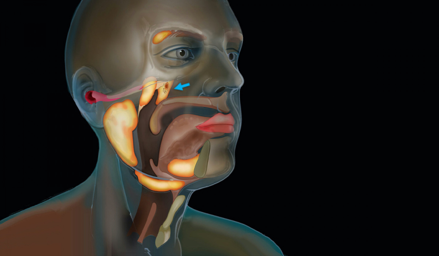Видалення слинних залоз