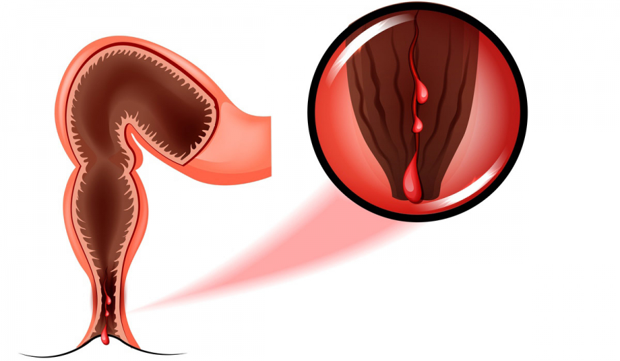 Анальна тріщина!