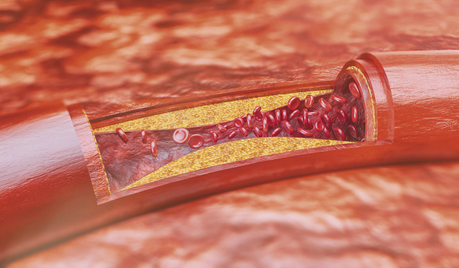 Облітеруючий атеросклероз