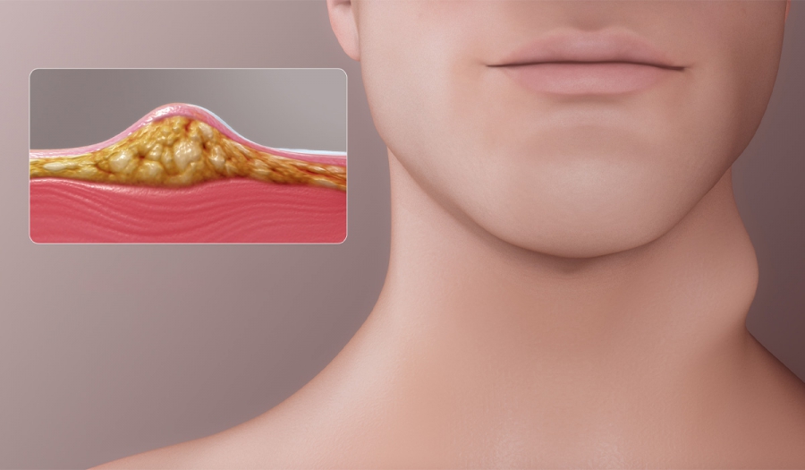 Доброякісні новоутвори шкіри (атероми, ліпоми). Лікування в МЦ «МЕДХАУЗ»