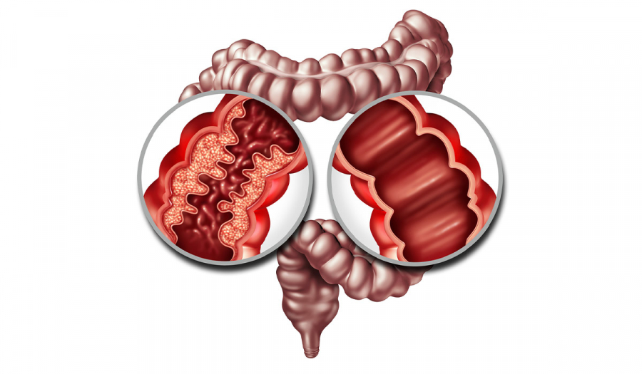 Хвороба Крона,що це за захворювання?