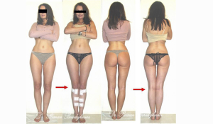 Ортопедо-косметична корекція вісі нижніх кінцівок.