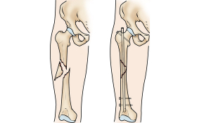 Оперативне лікування перелому стегнової кістки