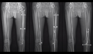 Подовження і корекція осі нижніх кінцівок в Івано-Франківську