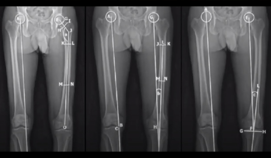 Подовження і корекція осі нижніх кінцівок в Івано-Франківську