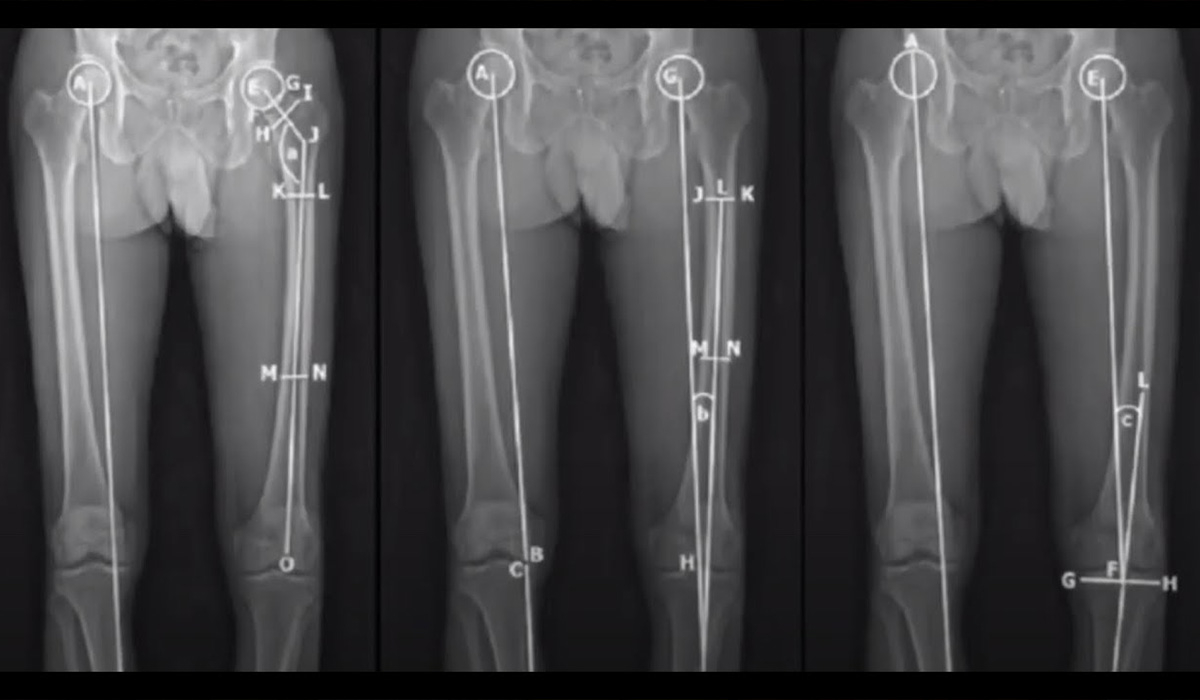 Подовження і корекція осі нижніх кінцівок в Івано-Франківську