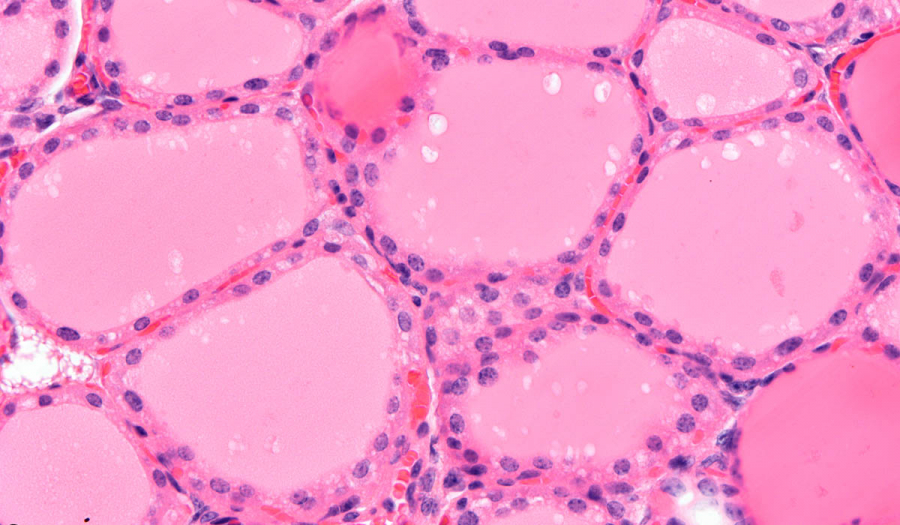 Інтраопераційна експрес гістологія щитоподібної залози в Івано-Франківську
