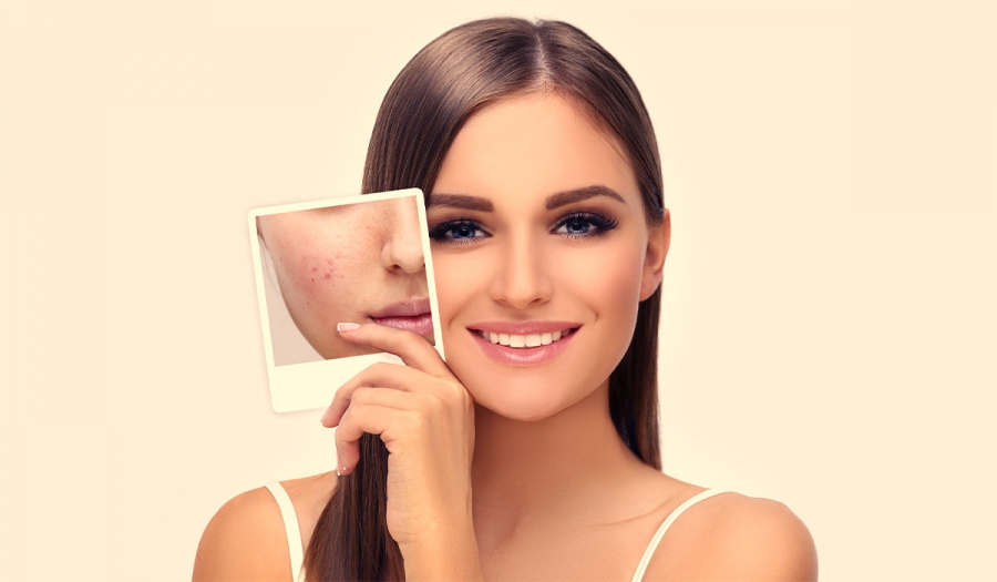 Безопераційна ринопластика