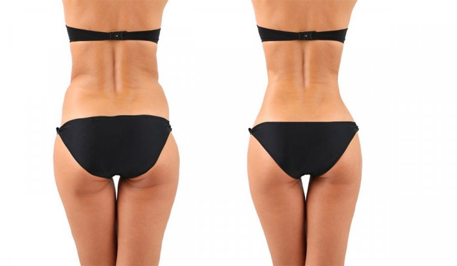 Ліпоскульптурування (ліпомоделювання) у Івано-Франківську