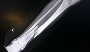 Лікування переломів гомілкової кістки