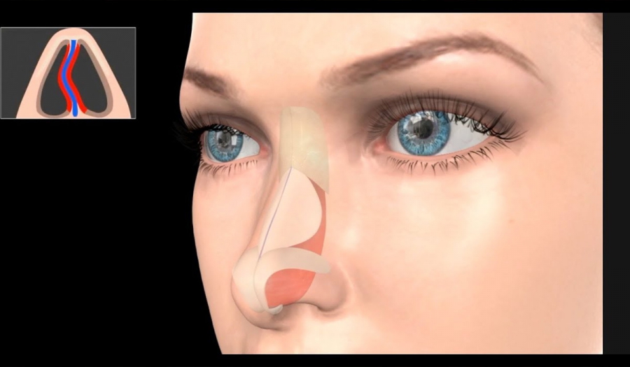 Септопластика Пластика носової перегородки у МЦ «МЕДХАУЗ»