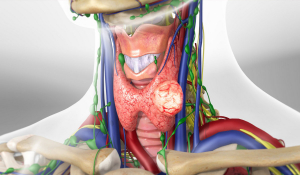Видалення щитоподібної залози в Івано-Франківську