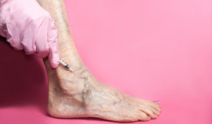 Склерозування вен