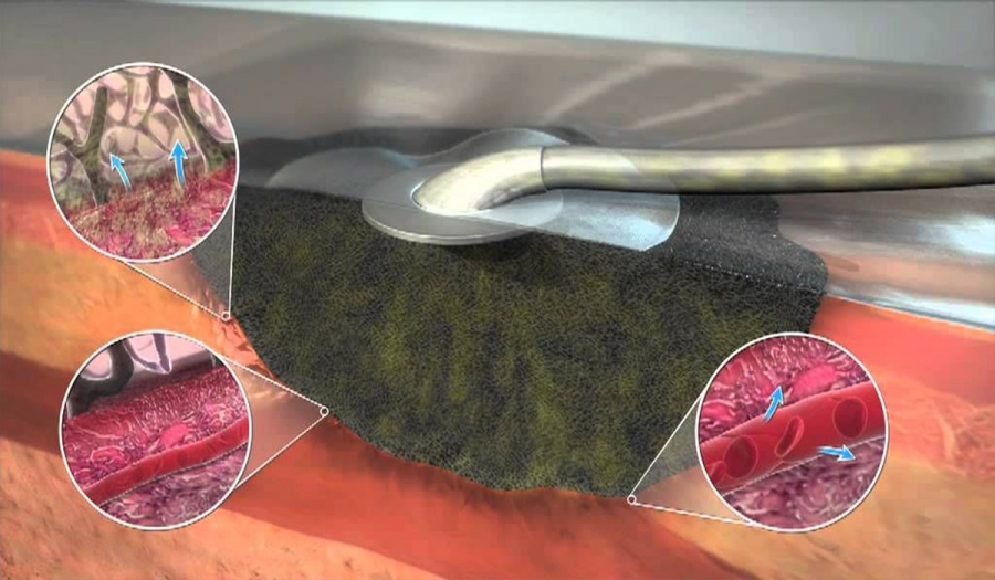 VAC- терапія  - ефективний порятунок від хронічних ран