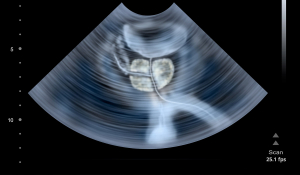 УЗД передміхурової залози: коли робити і як готуватися?