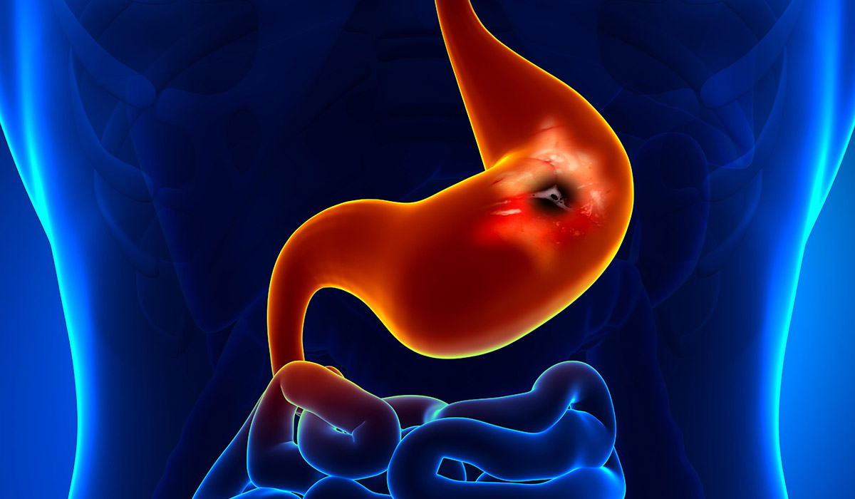 Ускладнення виразкової хвороби шлунку: причини та лікування у Івано-Франківську.