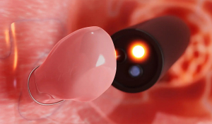 Видалення поліпів прямої кишки в Івано-Франківську