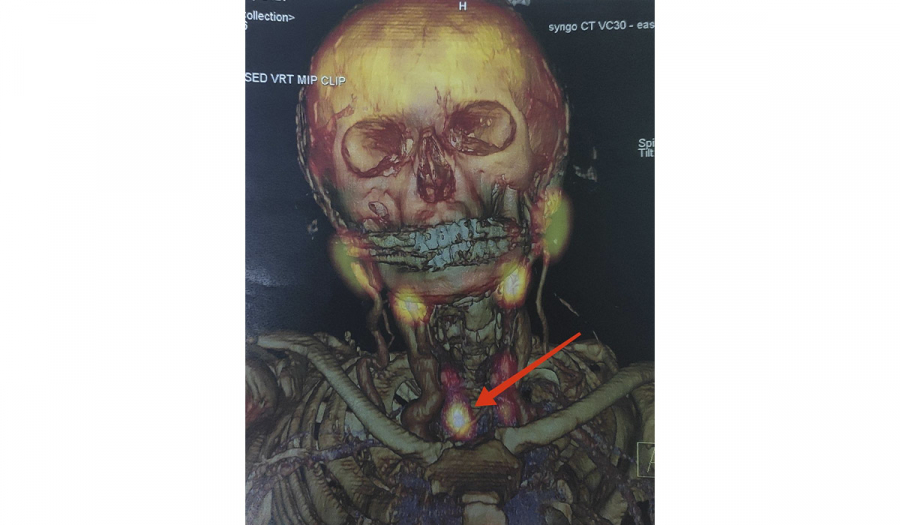 Аденома прищитоподібної залози і її наслідки для організму.