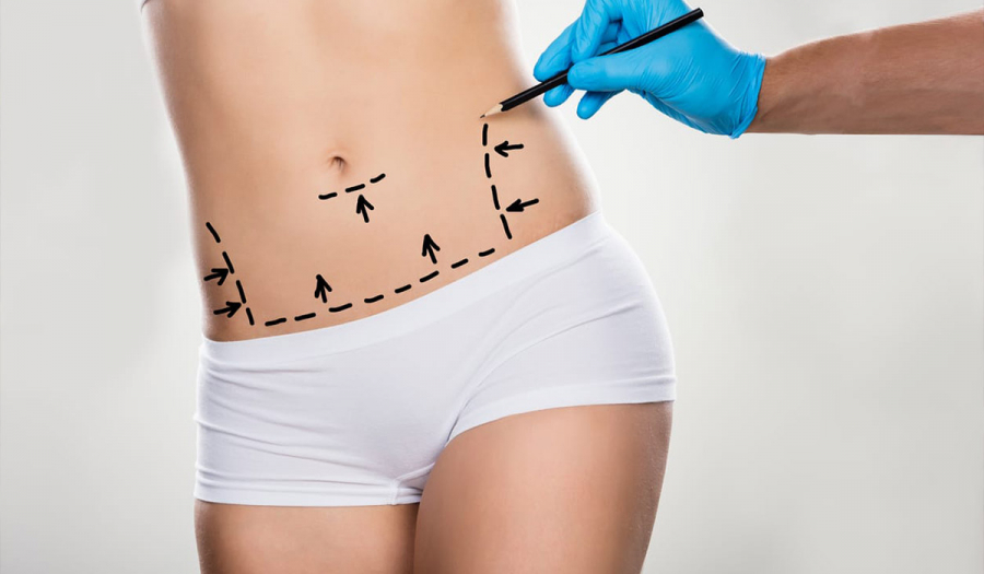 Абдомінопластика (пластика живота) в Івано-Франківську