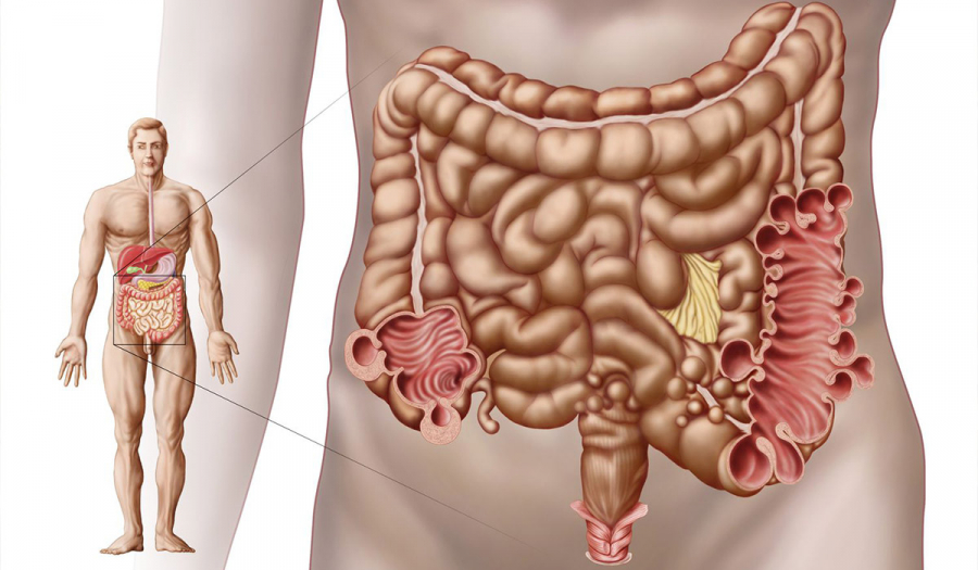 Дивертикульоз кишківника. Симптоми та лікування в Івано-Франківську.