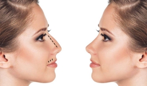 Ринопластика в Івано-Франківську